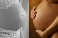 OMS denuncia 'epidemia' de cesáreas no mundo; Brasil é líder