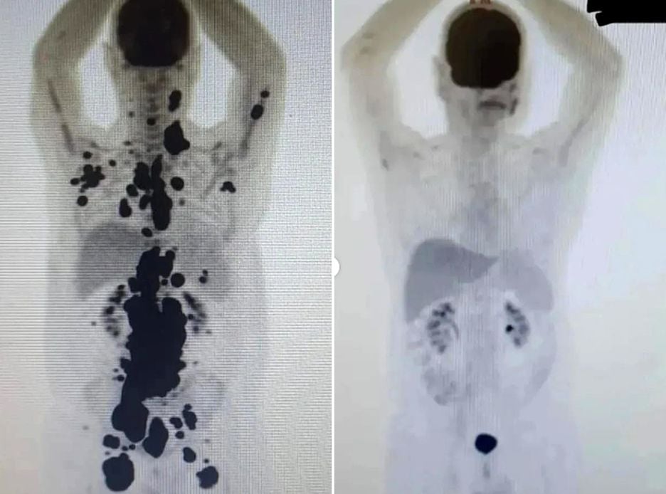 Exame de Paulo Peregrino antes da terapia CAR-T Cell, em comparação com um atual, mostra a remissão dos linfomas não-Hodgkin.