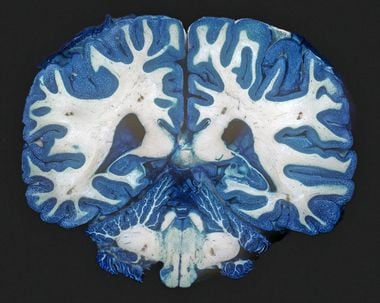 Pesquisas sugerem que, no cérebro de pessoas com depressão crônica, as áreas de “substância branca” ricas em fibras nervosas têm menos conexões. A causa dessa diferença é incerta, no entanto.
