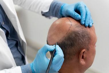 Hair transplantation can be an alternative in cases of irreversible hair loss