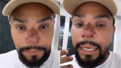 Naldo Benny sofre de princípio de necrose no nariz após fazer rinomodelação