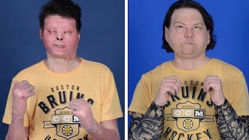 Fotos mostram o americano Joe DiMeo, de 22 anos,antes e depois dos transplantes de face e mãos. Foto: REUTERS