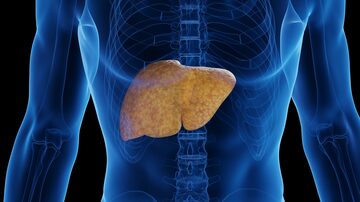 3D medical illustration of a man's fatty liver. Foto: Sebastian Kaulitzki/Adobe Stock