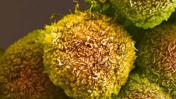 Uma imagem colorida de microscópio eletrônico de varredura de células cancerígenas pancreáticas. Foto: Anne Weston/Francis Crick/ Institute, via Science Source/NYT