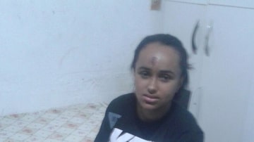 Jussara Araújo de Souza, de 23 anos, ficou com diversos hematomas no corpo e teve que levar 30 pontos na perna esquerda. Foto: Jussara Araújo de Souza/Arquivo Pessoal