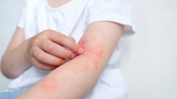 The child scratches atopic skin. The child applies a special cream to atopic skin. Dermatitis, diathesis, allergy on the child's body. Foto: Марина Терехова/Adobe Stock
