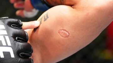 Brasileiro é mordido em luta do UFC e eterniza marca na pele. Foto: Reprodução/Instagram @ufc_brasil