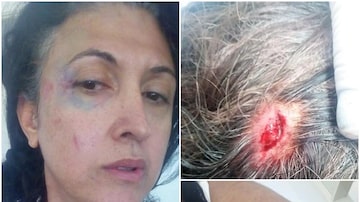 Fotos divulgadas pela trans Angela Lopes mostram os ferimentos. Foto: Angela Lopes/Facebook