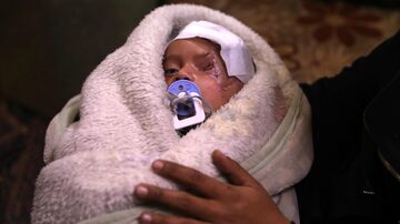 Bebê sírio perdeu um olho após ataque aéreo na Síria. Foto: EFE/ Mohammed Badra