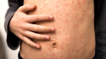 Sick child body, stomach with red rush spots from measles or chicken pox. Contagious child diseases and treatment. Foto: bilanol/Adobe Stock        