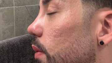 Rico Melquiades mostra resultado com 'antes e depois' de cirurgia plástica no nariz. Foto: Instagram/@ricoof 