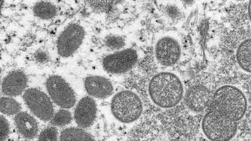 Imagem de microscópio eletrônico mostra sinais da varíola dos macacos em uma amostra de pele humana. Foto: CDC via AP