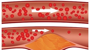 Doença coronariana resulta da formação de placas de tecido fibroso e gordura que crescem e se acumulam na parede dos vasos sanguíneos. Foto: Divulgação