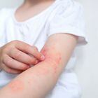 The child scratches atopic skin. The child applies a special cream to atopic skin. Dermatitis, diathesis, allergy on the child's body. Foto: Adobe Stock 