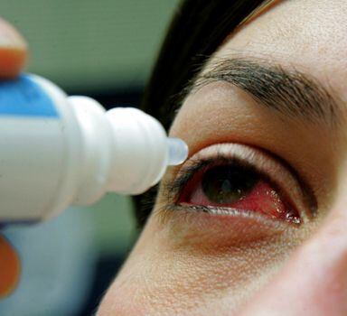 Conjuntivite é a inflamação da mucosa que protege a parte branca dos olhos.