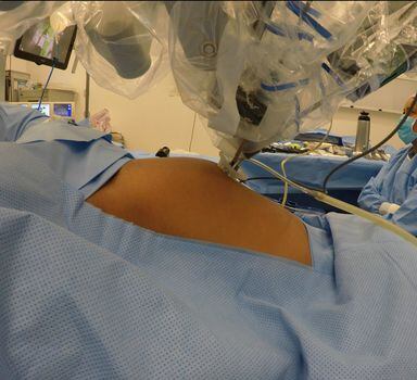 Robô usado em cirurgia de remoção de tumor no colo doútero
